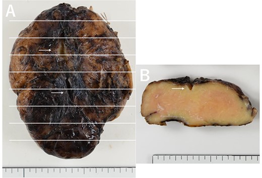 Macroscopic view (A) and cut surface (B) of the tumor. Impression of the sternal saw at the time of median sternotomy can be observed (white arrows).