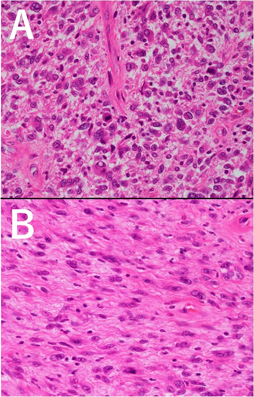 Microscopic view of the tumor (HE staining, ×200 magnification). (A) pleomorphic area, (B) spindle cell area.