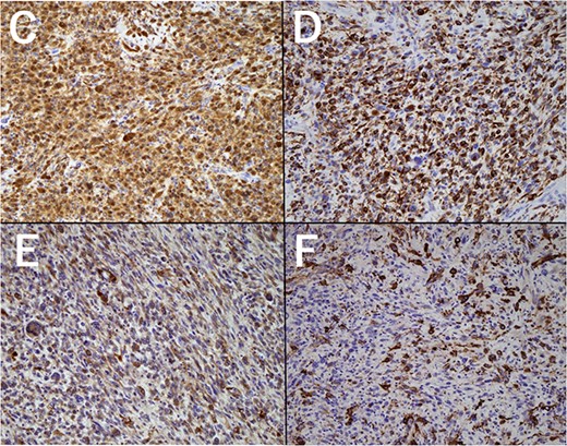 Immunohistochemical staining of the tumor (×200 magnification). (C) p16, (D) Desmin, (E) Muscle-specific antigen, (F) α-smooth muscle actin.