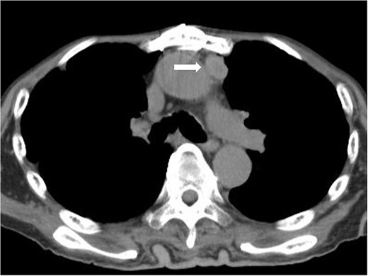 Chest CT scan 18 months after surgery. Mediastinal lymph node recurrence was suspected.
