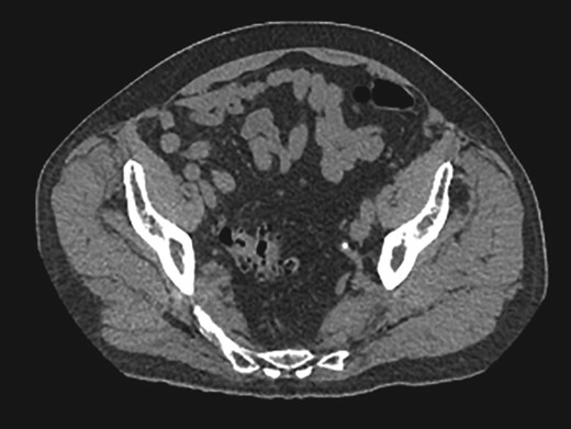 Right inguinal hernia containing bowel.