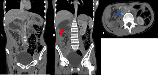Contrast CT abdomen—coronal (A and B) and axial views (C) show small bowels on the right side of the abdomen and the large bowels on the left side of the abdomen. Image B shows distended duodenum (red arrow). Image C shows twisting of the mesentery and the superior mesenteric artery giving whirlpool sign appearance (blue arrow).