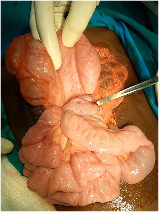 Twisting of duodenum around the SMA (probe).