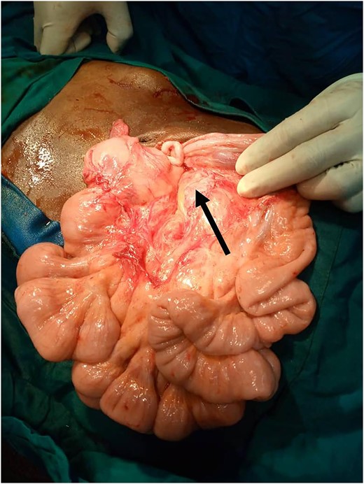 Post Ladd’s procedure; widened base of mesentery (arrow).