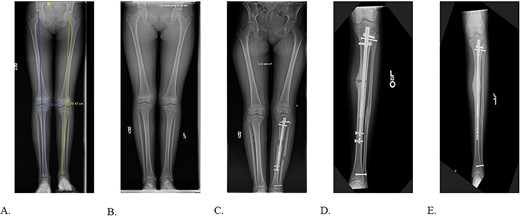 A: 10.5-year-old female with fibular hemimelia, affected left side. B: 11-year-old female status post right distal femur and proximal tibia epiphysiodesis. C: 8-weeks status post left tibia/fibula osteotomy and PRECICE implantation. D: 9-month postoperative PRECICE implantation of left tibia with delayed union. E: 3-months postoperative dynamization of left tibia with osseous union.