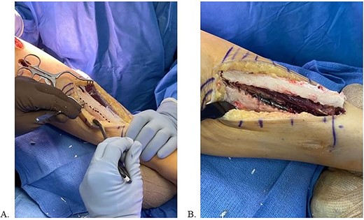 A: Multi-drill hole technique used to facilitate unroofing osteotomy. B: Completed unroofing osteotomy with visible implant.