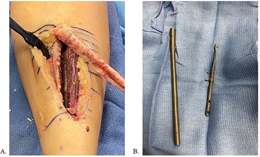 A: Left tibia after implant removal. B: Removed components.