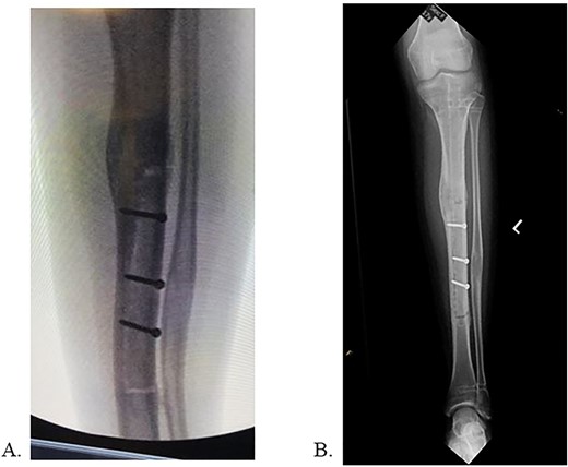 A: Intraoperative radiograph demonstrating complete implant removal with x3 fixation screws. B: 6 weeks postoperative radiographs demonstrating maintained alignment at osteotomy site.