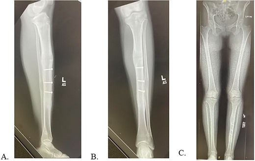 A: 12 months postoperative PRECICE explantation with osseous union at osteotomy site of lateral left tibia. B: 12 months postoperative PRECICE explantation with osseous union at osteotomy site of AP left tibia. C: 12 months postoperative PRECICE explantation with equal limb lengths and alignment.