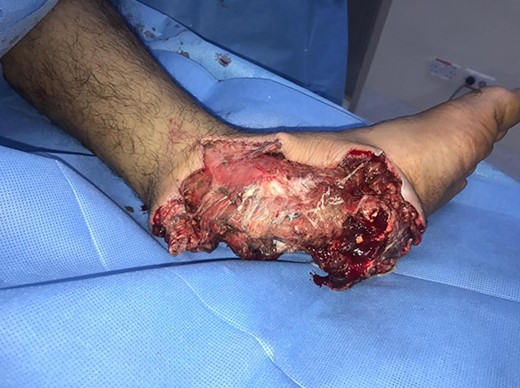 Intraoperative image of the left foot depicting the extent of injury.