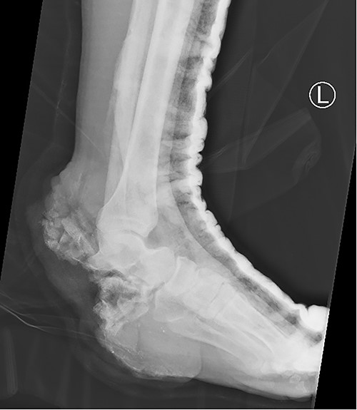 X-ray of the left foot showing complete loss of the calcaneus bone.