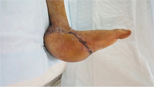 Post-operative image of the injured left foot 3 weeks after flap coverage.