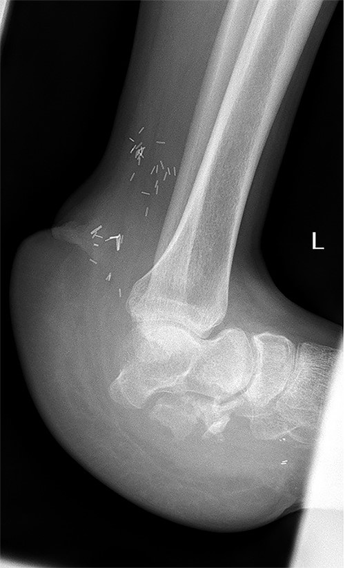X-ray of the left foot 18 months post flap coverage showing a stable talonavicular joint.