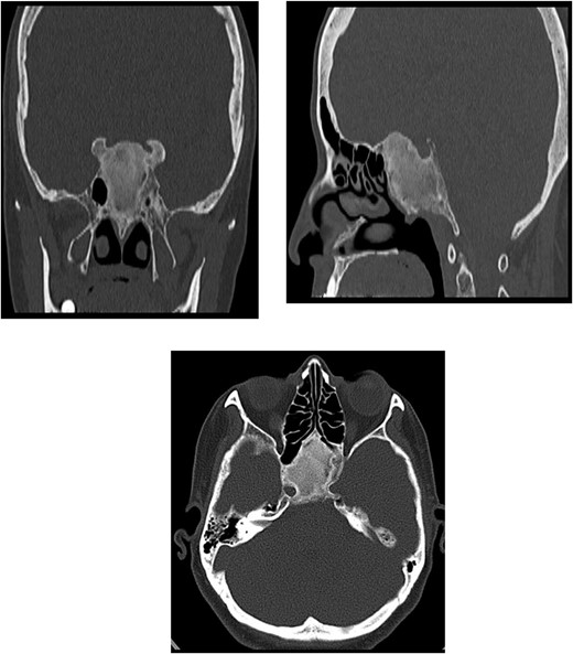 CT of the paranasal sinuses showing expansion of the sphenoid bone demonstrating diffuse ground-glass matrix and sclerosis obliterating the sphenoid sinus cavity.