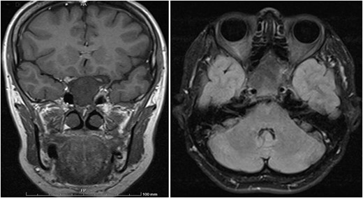 Coronal T1 image showing the expansion of the clivus with heterogeneous predominantly low T1 signal. Axial flair images showing the anteroposterior (AP) extension of the mass lesion with obliteration of the sphenoid sinuses. The cavernous portions of both internal carotid arteries (ICAs) have signal void intensity suggesting patency.