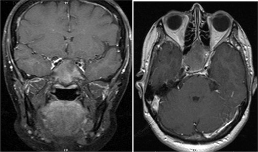 T1 axial and coronal post-contrast images show some heterogeneous enhancement compared to pre contrast images.