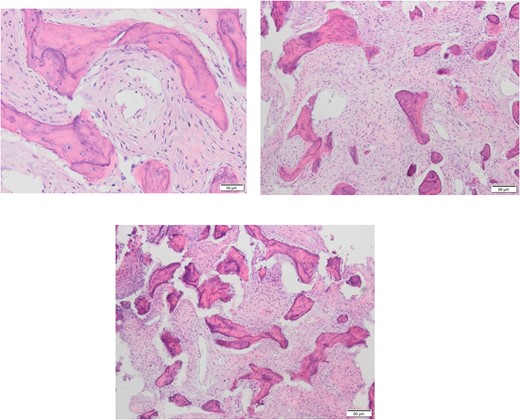 Different Histopathological slides confirming the diagnosis of fibrous dysplasia which presents under microscope as branching irregular trabeculae of woven bone with no osteoblastic rimming. There is intervening hypocellular fibrous stroma.
