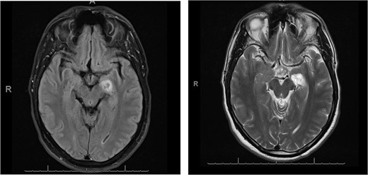 Flair sequence showing the lesion in the left amygdala as hypointense with surrounding hyperintense edema (links). T2-weighted imaging presenting the lesion hyperintense in the left amygdala (right).