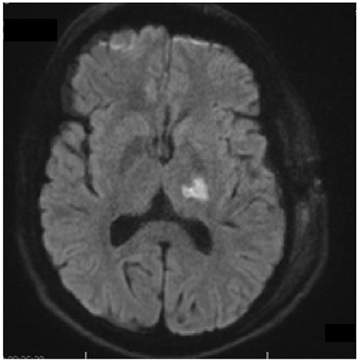 Axial diffusion-weighted MRI shows restricted diffusion in the posterior limb of internal capsule.