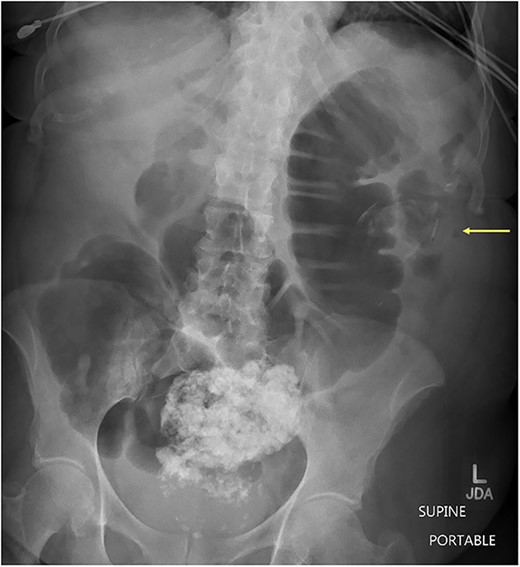 Supine abdominal x-ray showing colonic dilation secondary to large enterolith within the descending colon. (Arrow pointing enterolith).