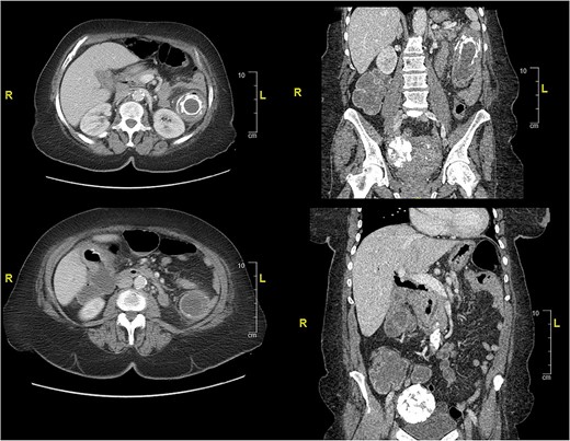 CT of abdomen and pelvis showing an inflamed gallbladder with fistulous communication within the hepatic flexure of the colon. Large descending colon enterolith (4.5 × 4.3 × 8.0 cm). Apparent pneumobilia.