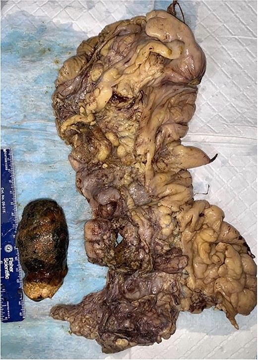 Operative specimen showing the segment of the colon resected with the fistula identified and the large enterolith extracted.