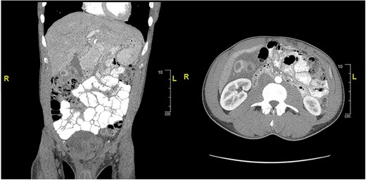 CT of abdomen and pelvis showing peripherally hyperdense septated collection within the porta hepatis with surrounding fluid signal attenuation likely representing an abscess seen around the gallbladder.