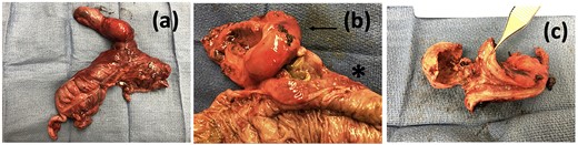 Operative specimen showing the gallbladder and colon resected in bloc (a) En-bloc specimen (b) Gallbladder (arrow) tightly adherent to colon (start) and (c) macroscopic appearance of the cholecystocolonic fistula.