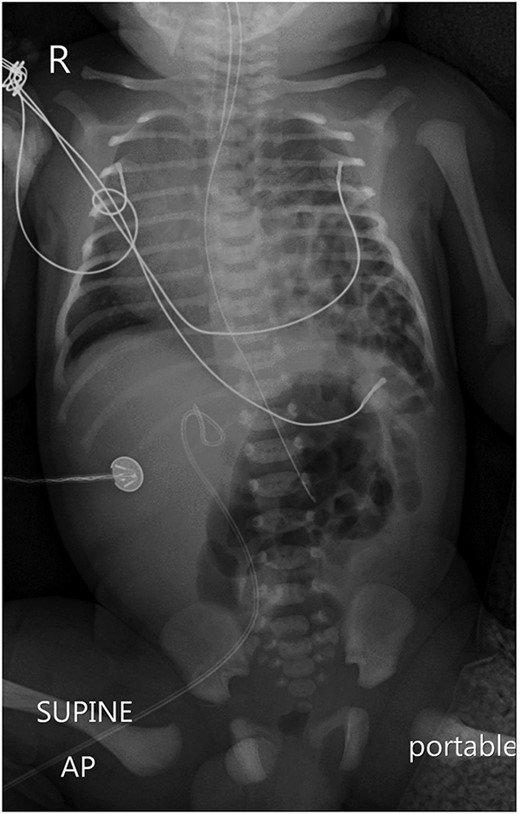 A portable X-ray photo of the chest, abdomen and pelvis shows the right mediastinal shift, total collapse of the left lung, partial collapse of the right lung and air-filled structures (bowel loops) extending from the abdomen into the chest.