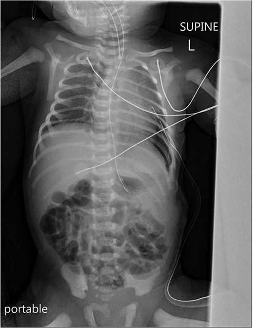 A portable X-ray photo of the chest, abdomen and pelvis taken postoperatively shows the expansion of both lungs and midline mediastinal position. A small subpulmonic pneumothorax on the left side is visible, for which a chest tube was inserted.