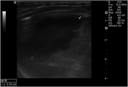 Abdominal ultrasound conducted 1 week post-operatively showed a possible splenic hematoma, which was self-limiting.
