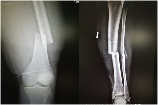 Ipsilateral femoral and tibial shaft fracture of the left limb (floating knee).
