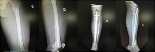 Post-operative view of the left femur and tibia. Concomitant retrograde IM nailing and antegrade IM nailing were performed.