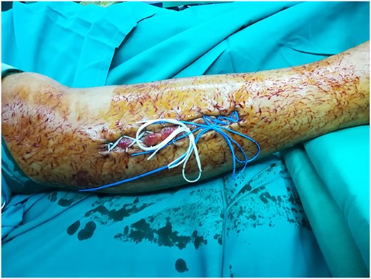 Progressive closure of the right uninjured tibia open compartments using the shoelace technique.