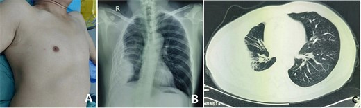 (A) Preoperative chest wall appearance; (B) X-ray examination and (C) computed tomography examination.