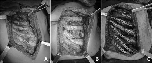 (A) The depressed ribs were exposed; (B) The ribs were cut in crisscross way and (C) The deformity was corrected with MatrixRIB.