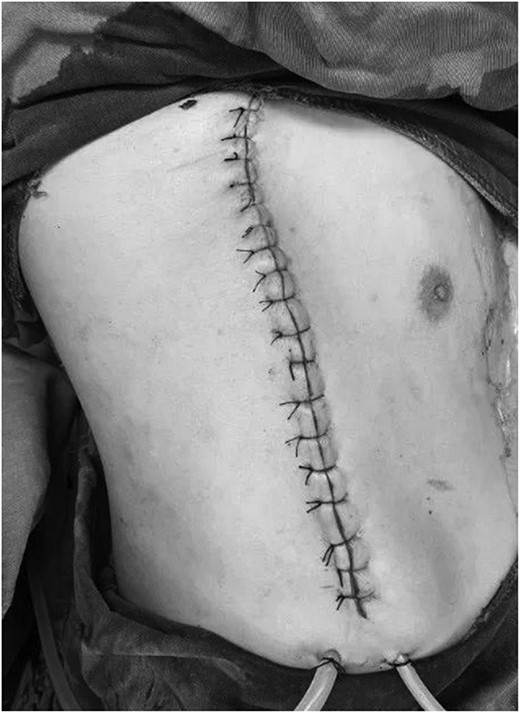 Postoperative chest wall appearance.