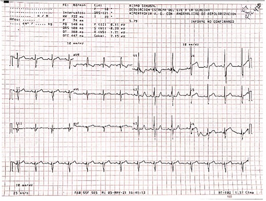 ECG displaying a normal sinus rhythm with right axis deviation suggestive of right ventricular hypertrophy
