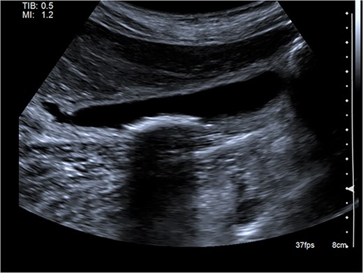 Abdominal ultrasound showing a distended gallbladder with multiple small calculi. There is no gallbladder wall thickening nor pericholecystic fluid.