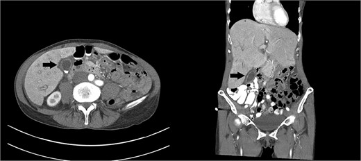 Axial and coronal images of a computed tomography showing a gallbladder (arrows) with multiple gallstones and pericholecystic fluid. Moderate hepatomegaly with heterogeneous enhancement and prominent hepatic veins are also present.