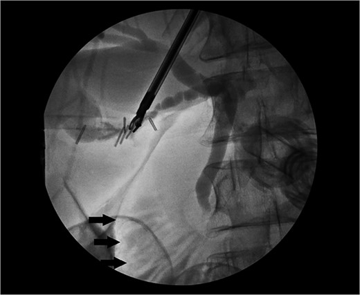 Intraoperative cholangiogram with contrast within the cystic, common hepatic and common bile duct with no filling defect to suggest choledocholithiasis. Contrast can be seen within the duodenum (arrows).