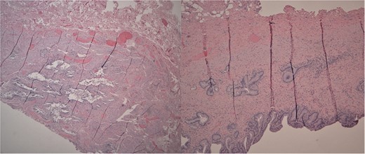 Left: Low power H&E of cystically dilated benign biliary glands accompanied by smooth muscle hypertrophy of the gallbladder wall consistent with adenomyomatous hyperplasia. Right: Low power section of fibrotic gallbladder wall with chronic inflammation consistent with chronic cholecystitis.