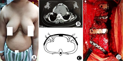 (A) Thorax appearance before operation; (B) CT scan image before operation; (C) schematic diagram of operation and (D) operation Picture.