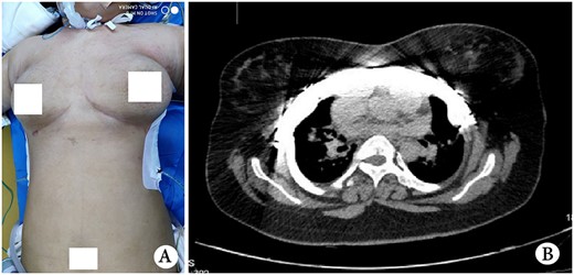 (A) Postoperative thorax appearance and (B) postoperative CT scan image.