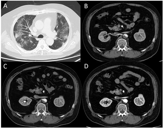 (A) Computed tomography (CT) image obtained on the first day. The bilateral lungs showed inflammation. (B) Enhanced CT image obtained immediately after developing acute limb ischemia. Intra-aortic thrombus was observed at the juxtarenal level. (C) Enhanced CT image obtained on post-operative day 11. The thrombus size had decreased. (D) Enhanced CT image obtained 1 month after surgery. The thrombus had further diminished.