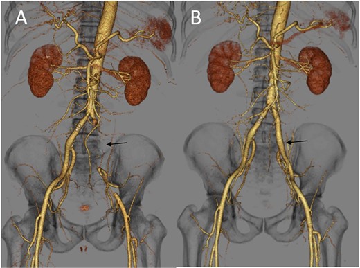 (A) Three-dimensional enhanced CT image obtained immediately after developing acute limb ischemia. The left iliac artery was occluded as indicated by an arrow. (B) Three-dimensional enhanced CT image obtained on post-operative day 11. A patent left iliac artery was observed, as indicated by an arrow.