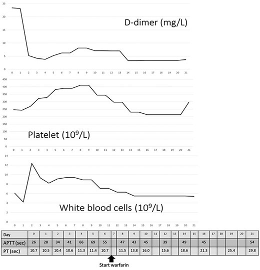 Changes in D-dimer levels, platelet and white blood cell counts, activated partial thromboplastin time and prothrombin time (PT). The horizontal axis refers to days of hospital stay. D-dimer levels had already increased on the day of hospitalisation (day 0) and decreased on day 3, which was after thrombectomy. Platelet counts had not decreased below 200 × 109/L. Unfractionated heparin was administered from day 0 until day 15 when PT was prolonged.