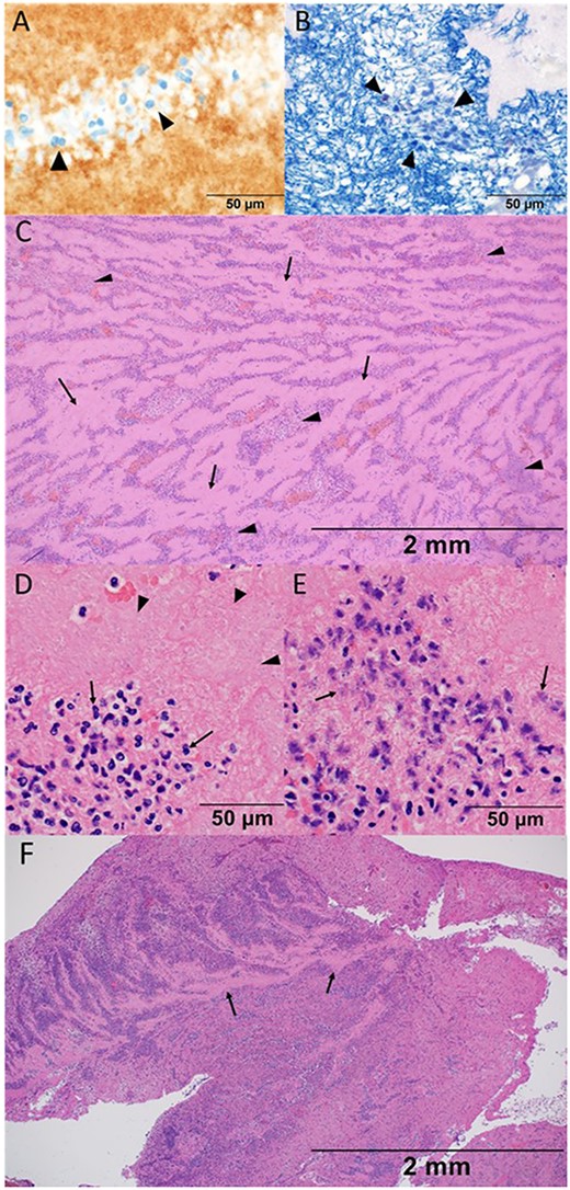Histological findings of thrombosis removed from the iliac artery in the present case (A–E), and in the other case without COVID-19 infection (F). (A) High-power view with a 50-μm measurement showing the platelet that was confirmed by the morphological feature with eosinophilic fragments as well as CD61 staining as indicated by arrow heads. (B) High-power view with a 50-μm measurement showing fibrin which was stained blue with phosphotungstic acid-hematoxylin stain. Fibrin network was constituted around the nuclei of the inflammatory cells, which was indicated by arrow heads. (C) Low-power view of hematoxylin and eosin stain with a 2-mm measurement showing the histological structure. Acellular pinkish area (arrows) was mildly distinguished with an inflammatory-cell aggregated area (arrow heads). (D) High-power view of hematoxylin and eosin stain with a 50-μm measurement showing the aggregation of neutrophils (arrows) and platelets (arrow heads). Note the clear margin of the nuclear membrane accompanied by neutrophils. (E) High-power view of hematoxylin and eosin stain with a 50-μm measurement. Note and compare the morphological features of neutrophils between (D) and (E). Pyknotic and fragment nuclei of neutrophils were observed (arrows). The elapsed time of the thrombus formation was difficult to assess based on the morphological features, either in the chronic or very acute phase. (F) Low-power view presenting many inflammatory cells that distributed diffusely in the non-COVID-19 case. Acellular area was recognised partially, as indicated by arrows, and did not compose stratification with inflammatory cells.