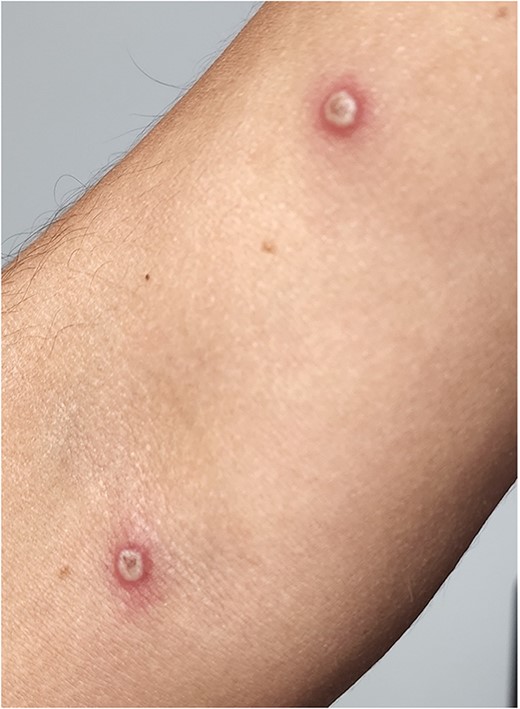 Multiple central umbilicated lesions over the forearm.