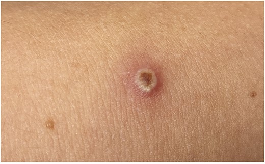 A closer view of the central umbilicated lesion.